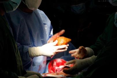 ABD'de kuduzlu böbrek nakli yapıldı: Hayatını kaybetti