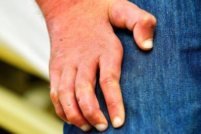 Romanya ve Hırvatistan'da 40 yılın ardından cüzzam vakaları görüldü