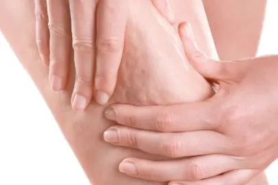 Prof. Dr. Karacalar’dan selülit uyarısı: Portakal kabuğu görüntüsü basit sorun değil!