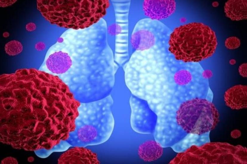Araştırma Sonrası İyileşen Koronavirüs Hastalarının Akciğerlerinde Bulundu!