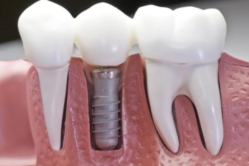 Bornova Ağız Ve Diş Sağlığı Merkezi Ayda 150 Diş İmplantı Yapıyor