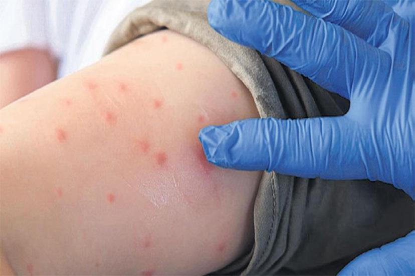 Bu yeni bir salgın mı? Önleme uyarısı