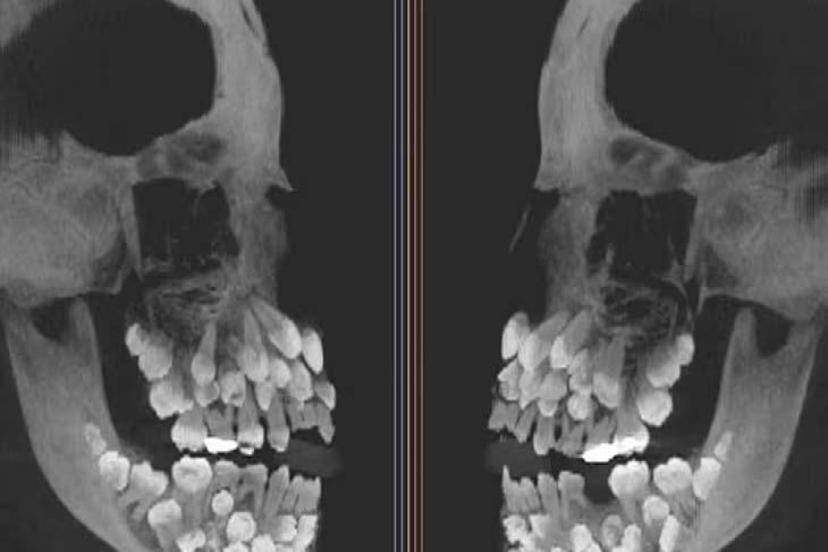 Çekime gitti, röntgen görüntüsü şoke etti! Ağzında 81 diş varmış