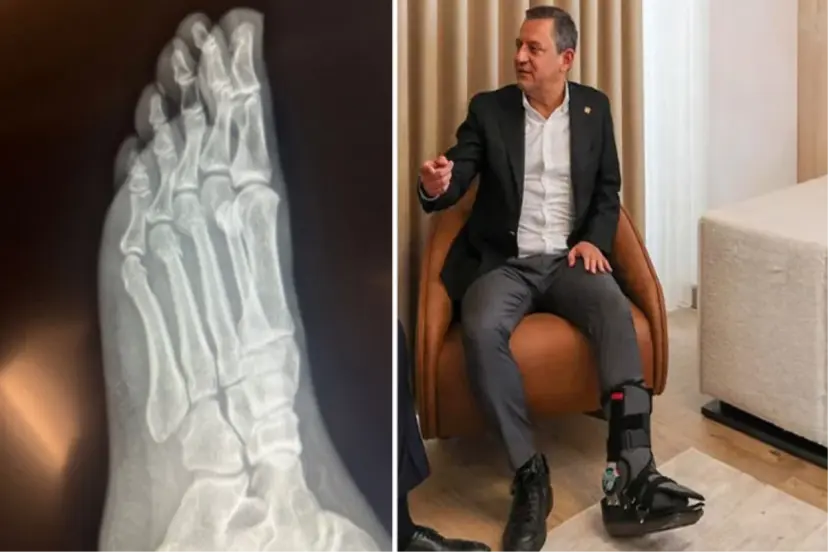 Özgür Özel'den "Vuruldu" iddialarına sert tepki! Ayağındaki kırıkların filmleri yayınlandı