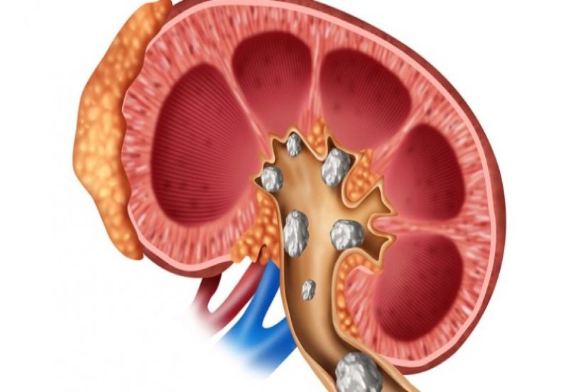 Ramazan Ayında Böbrek Taşı Kabusunuz Olmasın!