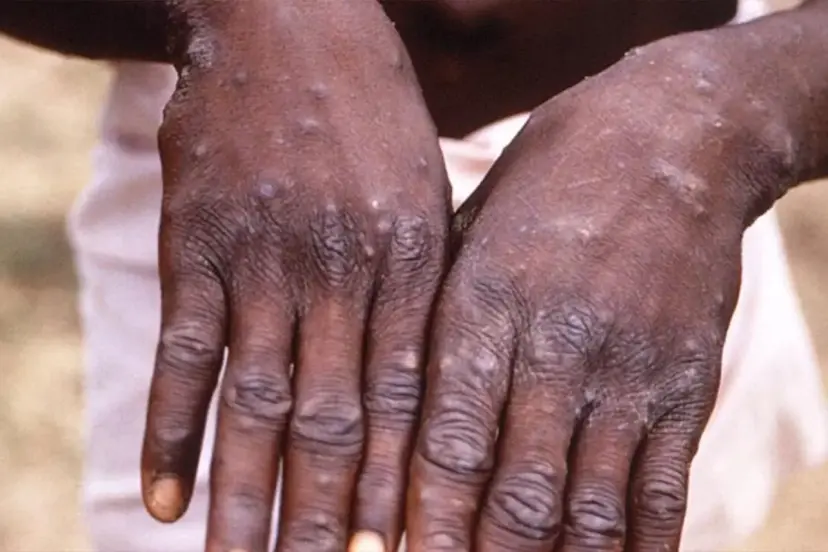 Uganda'da M Çiçeği salgınında can kaybı sayısı 37'ye yükseldi